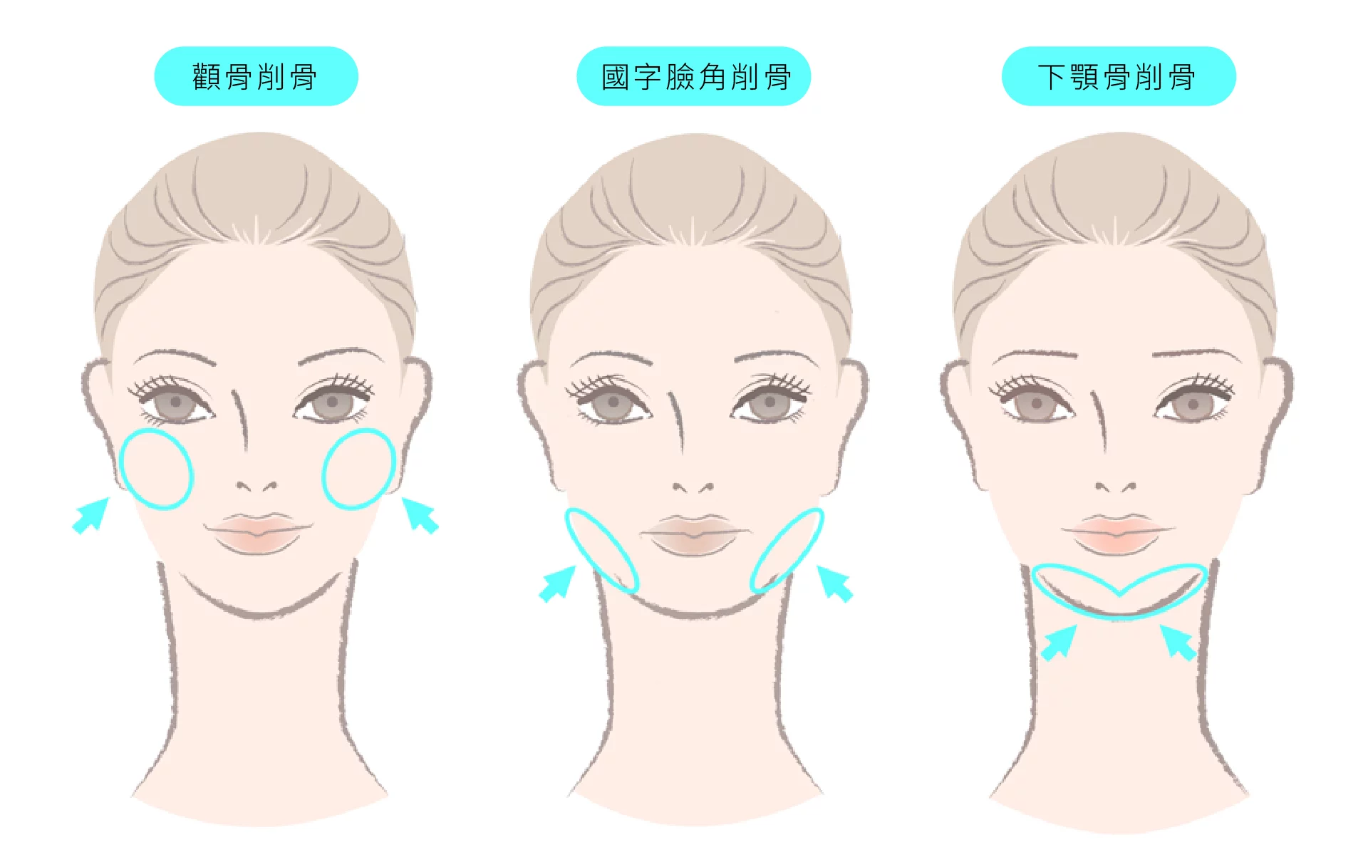 削骨手術 部位 1