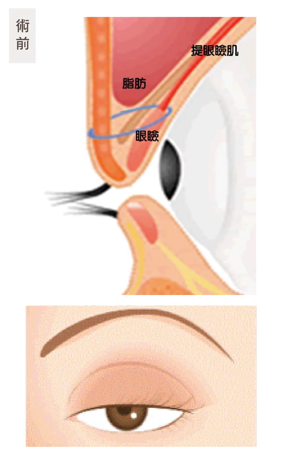 提眼瞼肌 術前