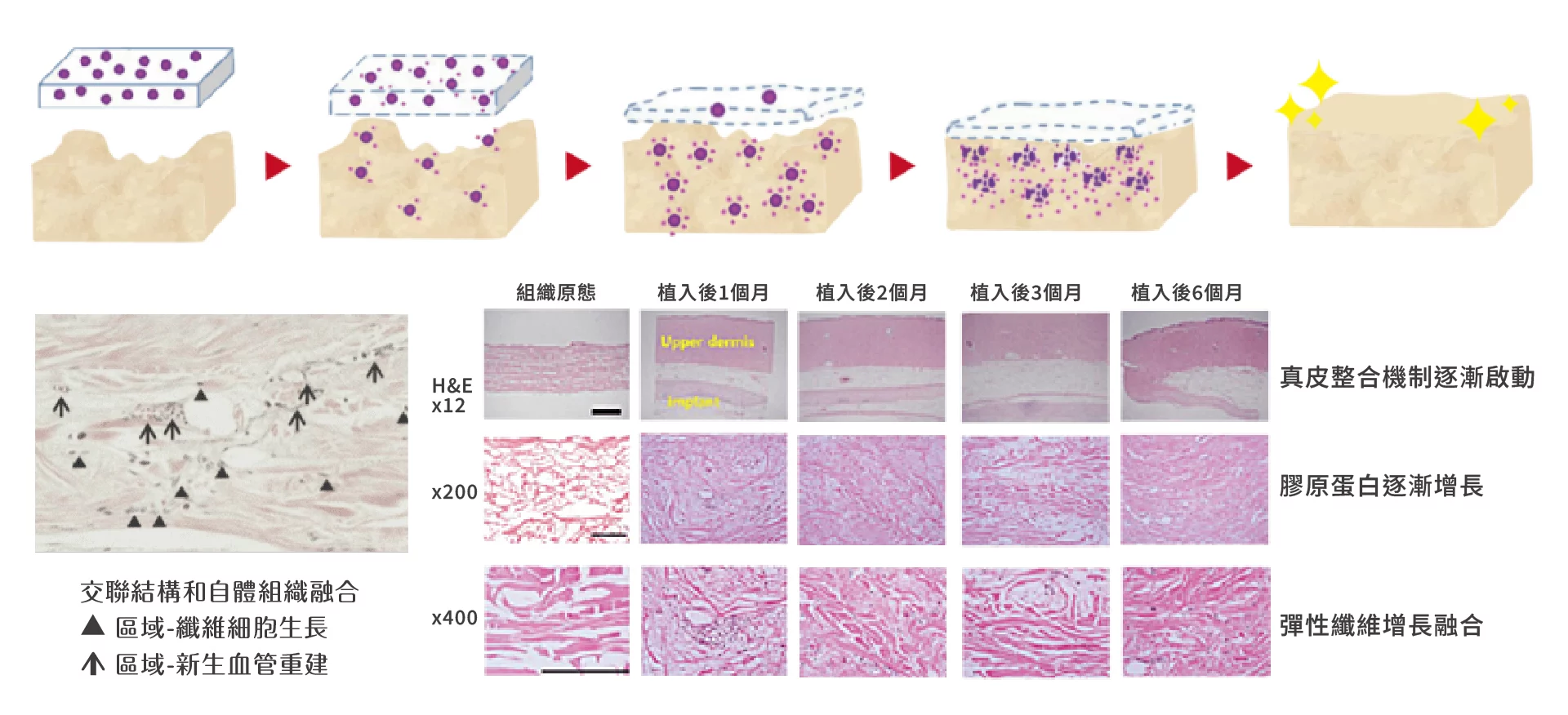 異體真皮粉 自體整合 1