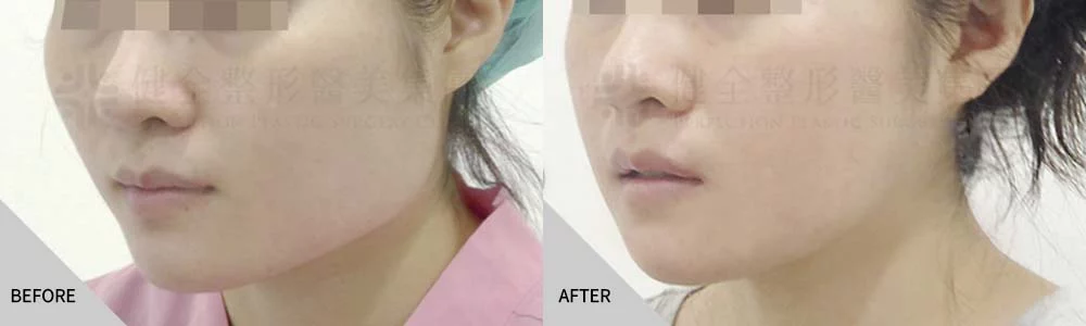 臉角削骨 02