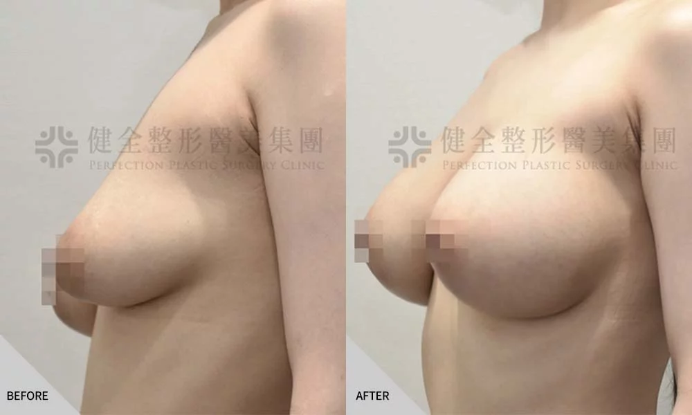 乳房下垂 04
