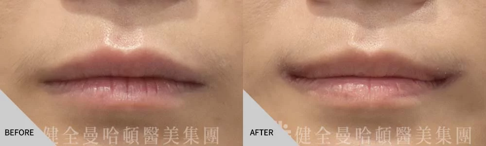 嘴角上揚 02 案例