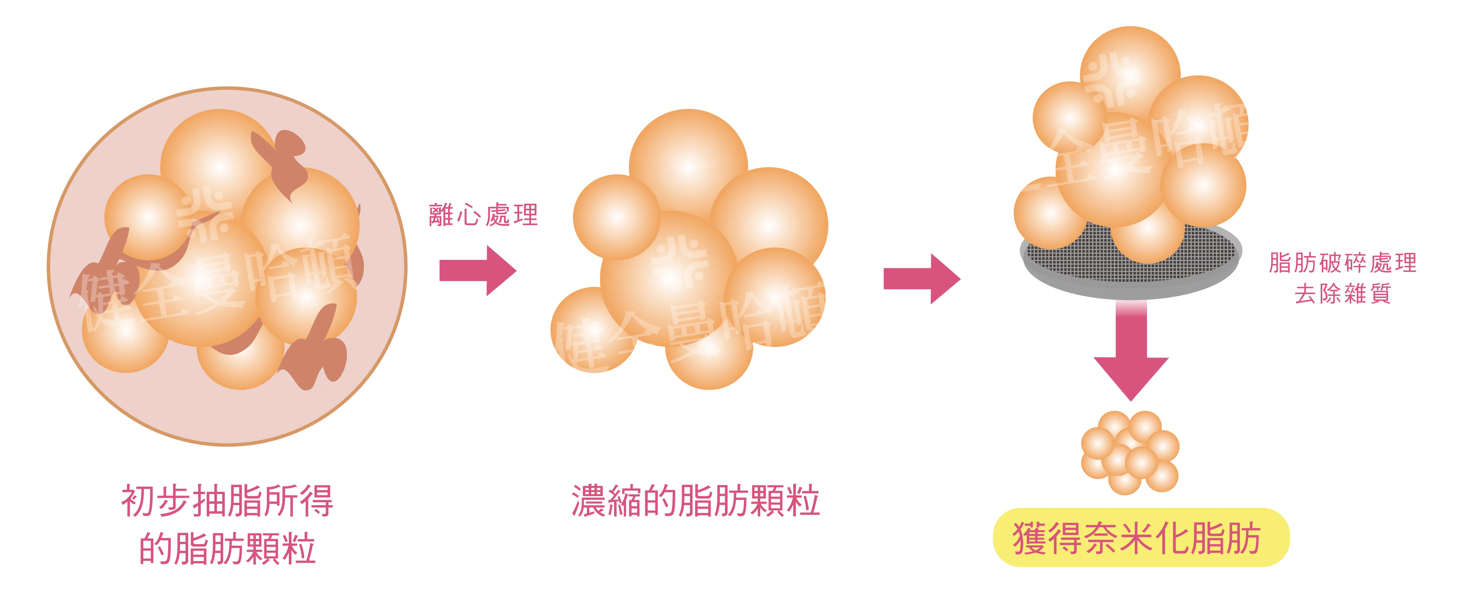 自體脂肪移植 03