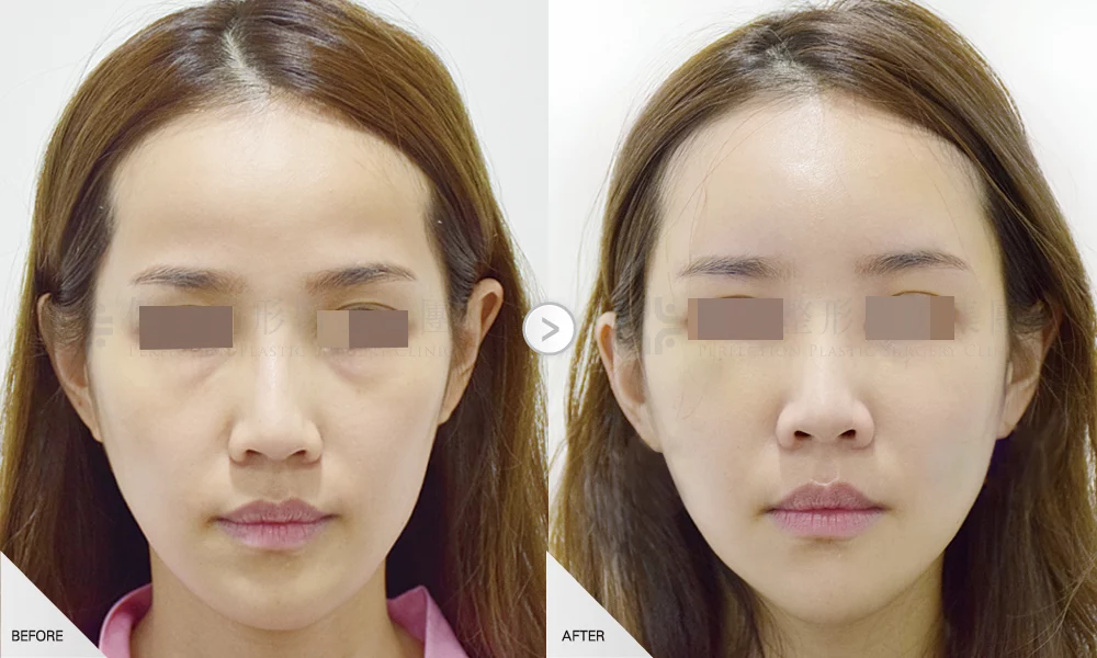 自體脂肪移植 案例 全臉補脂 01