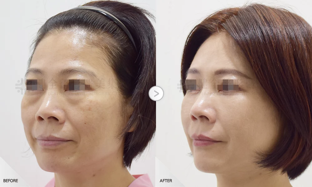 自體脂肪移植 案例 全臉補脂 02