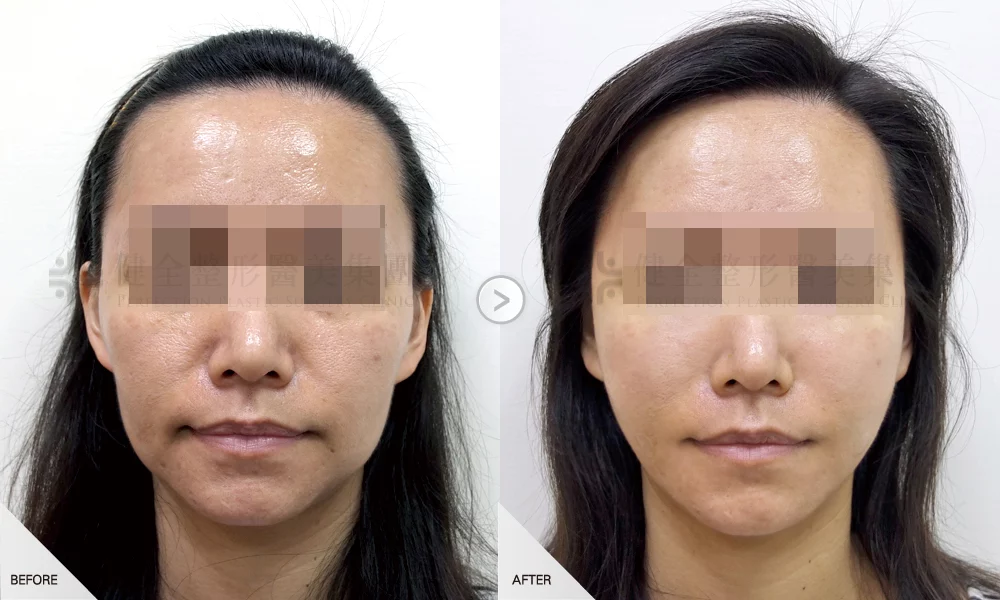 自體脂肪移植 案例 全臉補脂 04