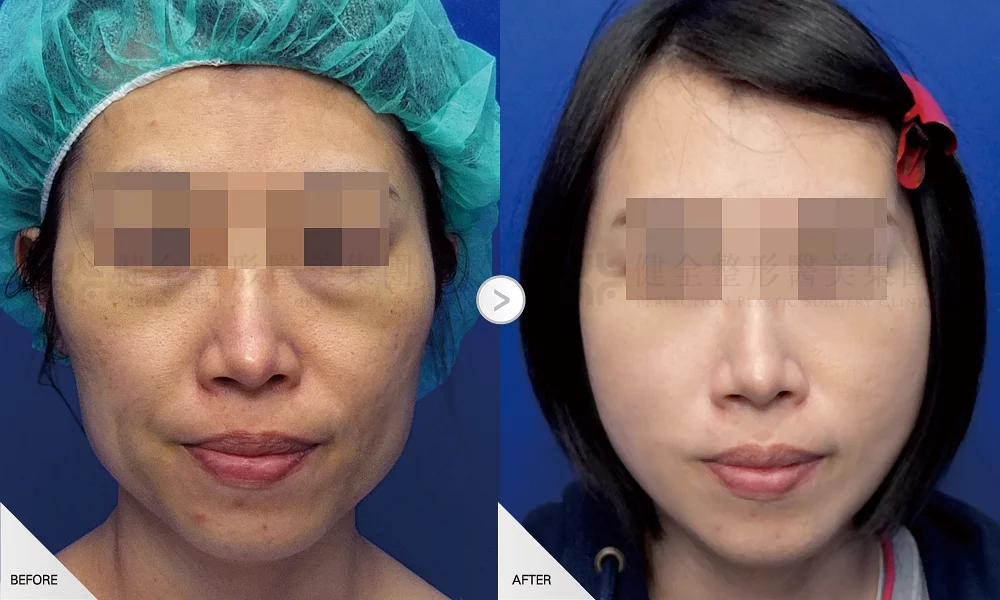 自體脂肪移植 案例 全臉補脂 06