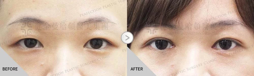 舊 吳佩臻8.84.5 縫雙眼皮開眼頭