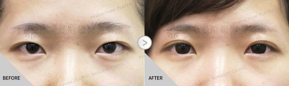 舊 姜采汝6.8縫雙眼皮