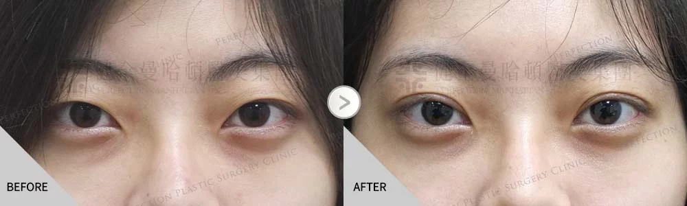 舊 林怡倫（11.1）1.15 縫雙眼皮