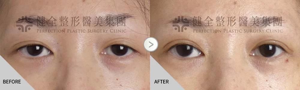 舊 梁嘉尹11.5 割雙眼皮提眼肌