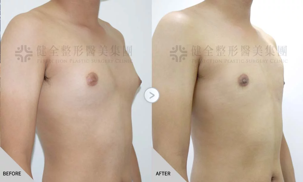 舊官網 男乳 乳腺型01