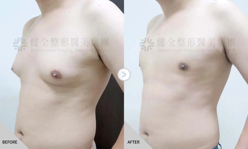 舊官網 男乳 乳腺脂肪內拉01