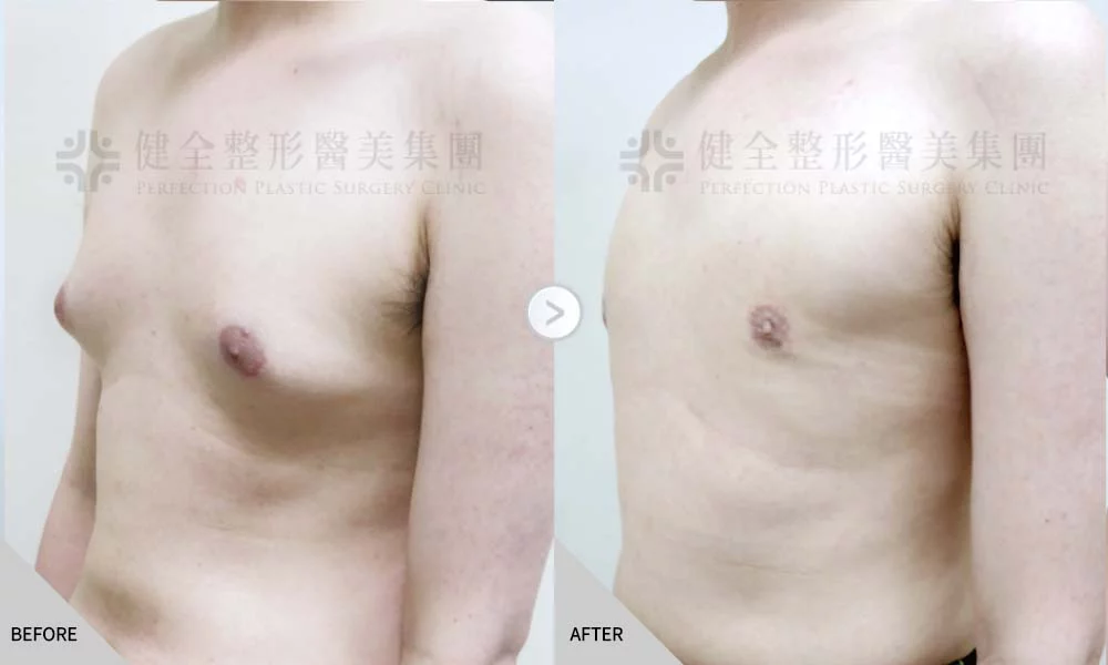 舊官網 男乳 乳腺脂肪內拉02