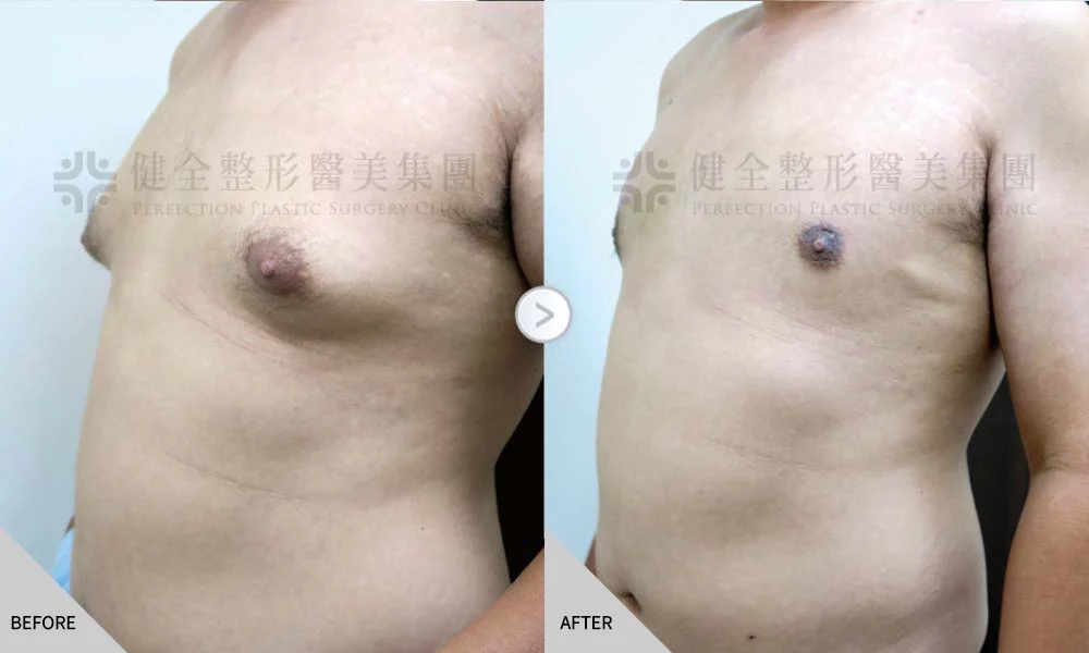 舊官網 男乳 乳腺脂肪內拉04