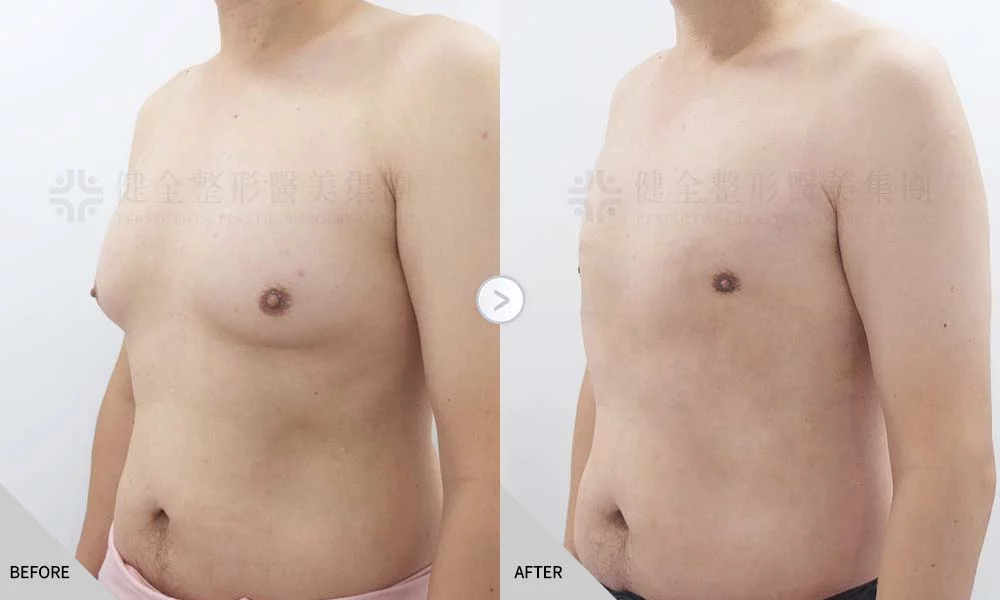 舊官網 男乳 乳腺脂肪型01