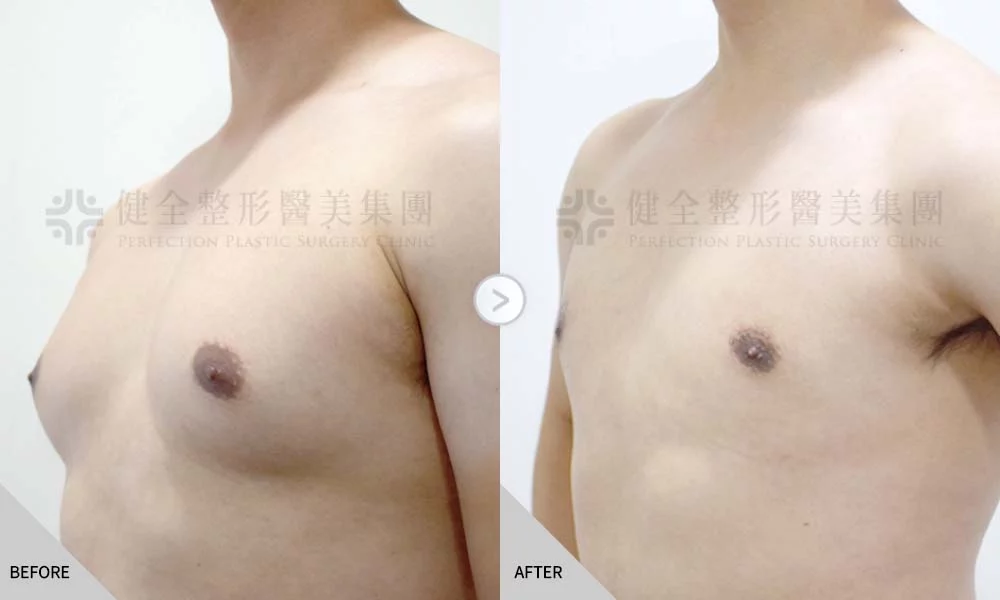 舊官網 男乳 乳腺脂肪型03