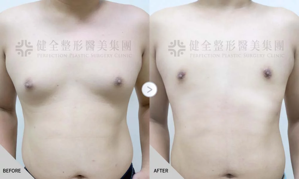 舊官網 男乳 脂肪型01