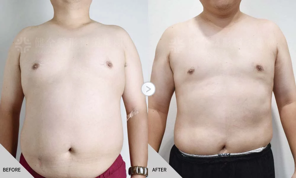 舊官網 男乳 脂肪型04