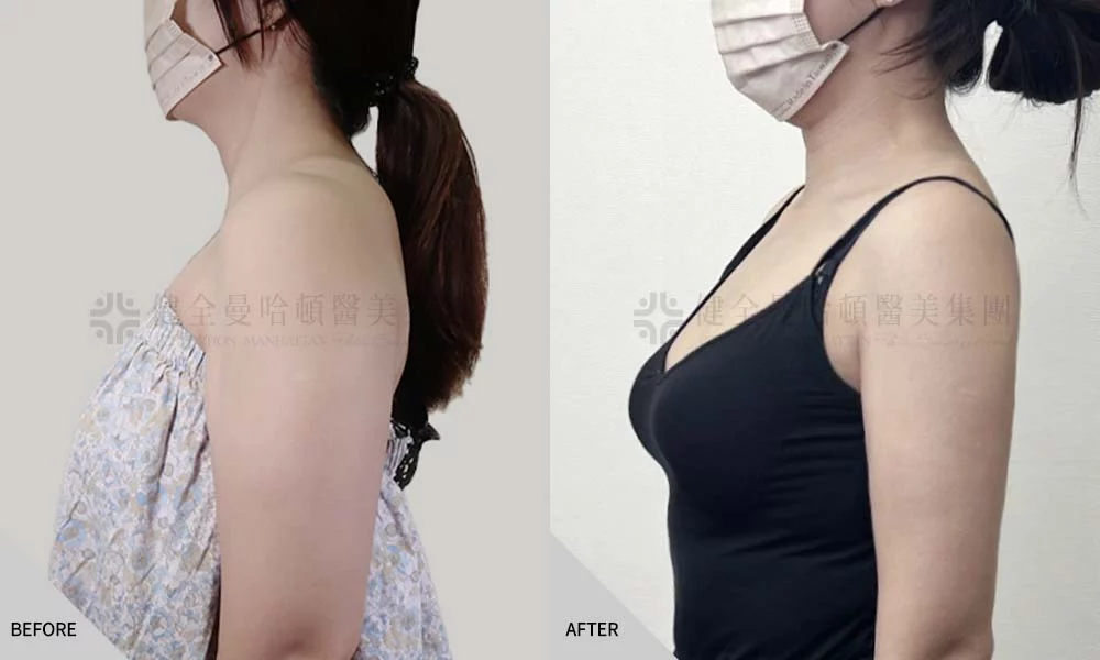 郭若潼 手臂抽脂 01