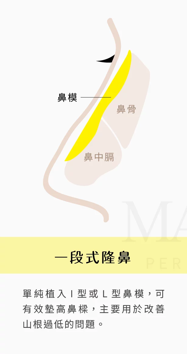 隆鼻 一段式