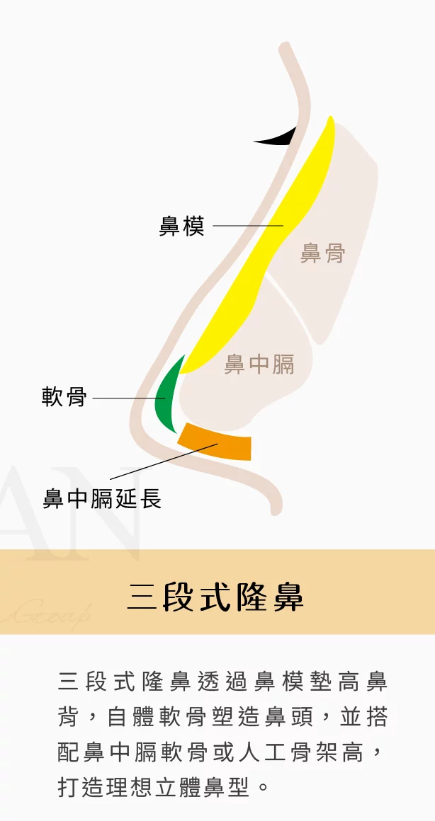隆鼻 三段式