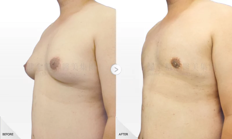 吳鈺泰 男性女乳 一字