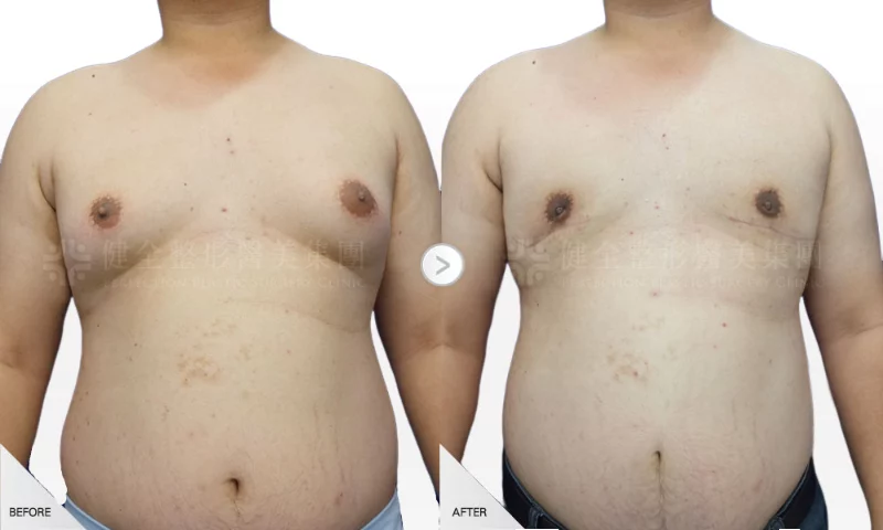 吳鈺泰 男性女乳2 一字