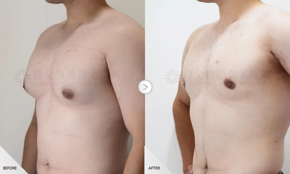 嚴重型 環拉乳暈2有銷像