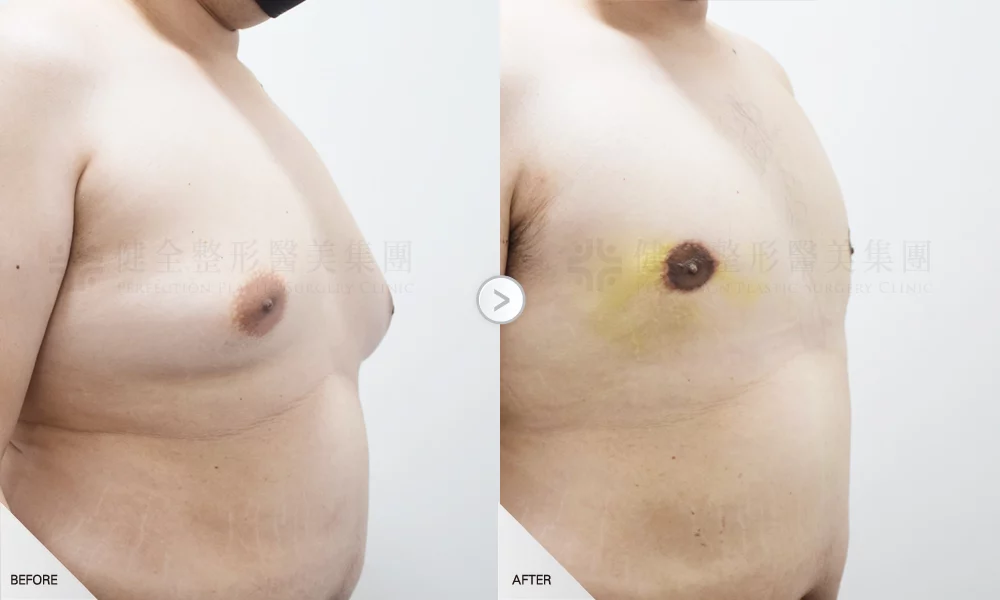 嚴重型 環拉乳暈4有銷像