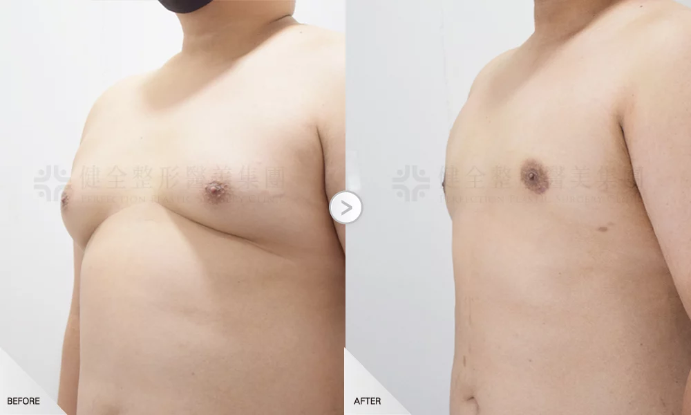 嚴重型 環拉乳暈5有銷像