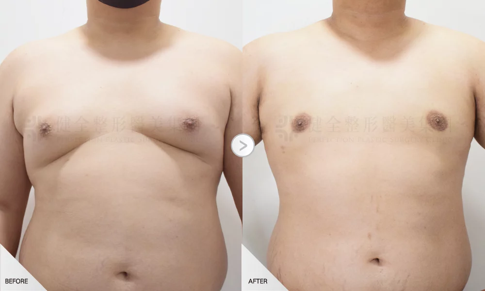 嚴重型 環拉乳暈6有銷像