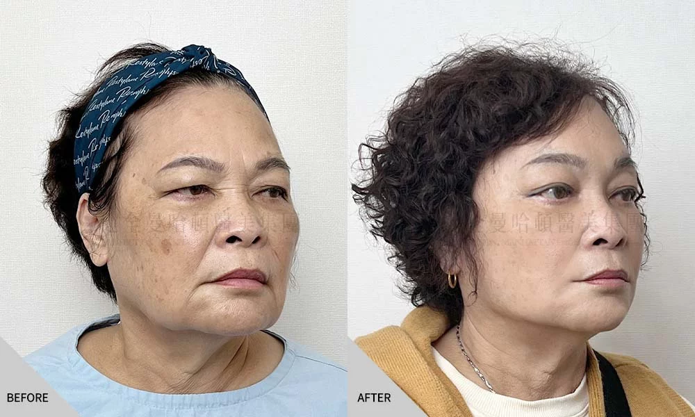 宋新蘭 全臉拉皮 02