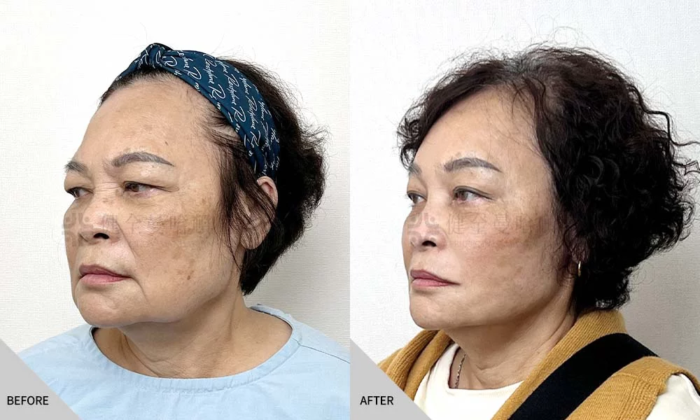 宋新蘭 全臉拉皮 03