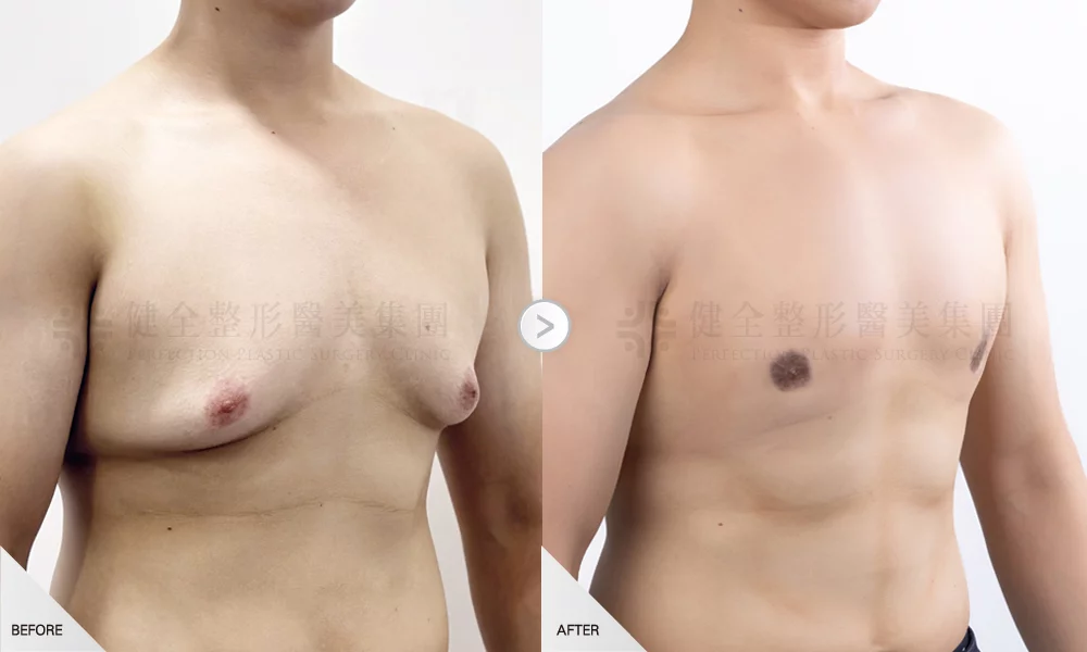 昱永有銷像環拉乳暈 個案