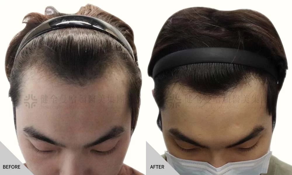 植髮 01