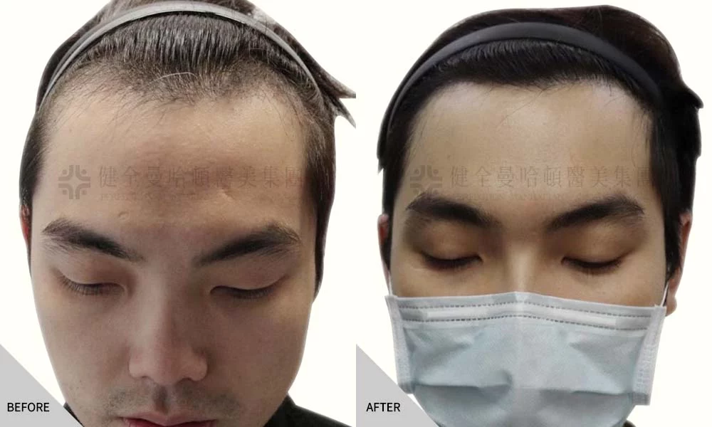植髮 02