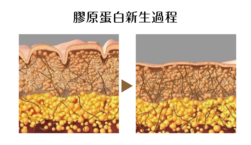 泡泡活氧 膠原蛋白新生過程