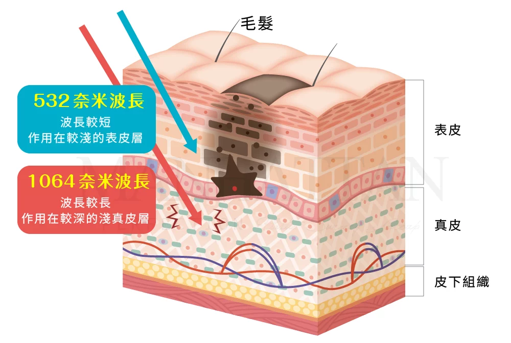 淨膚雷射 雙雷射波長 