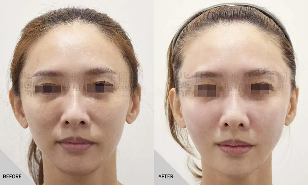 真童妍拉提術 04