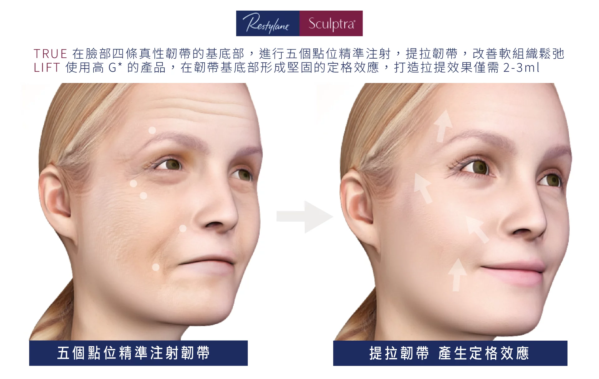 真童妍拉提術 提拉韌帶 