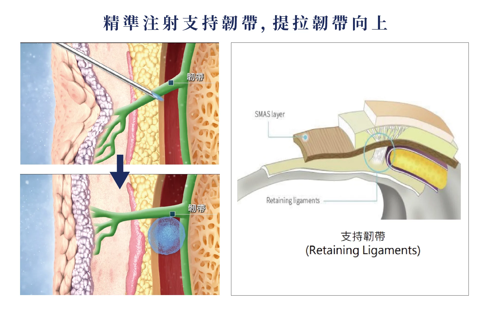 真童妍拉提術 韌帶向上