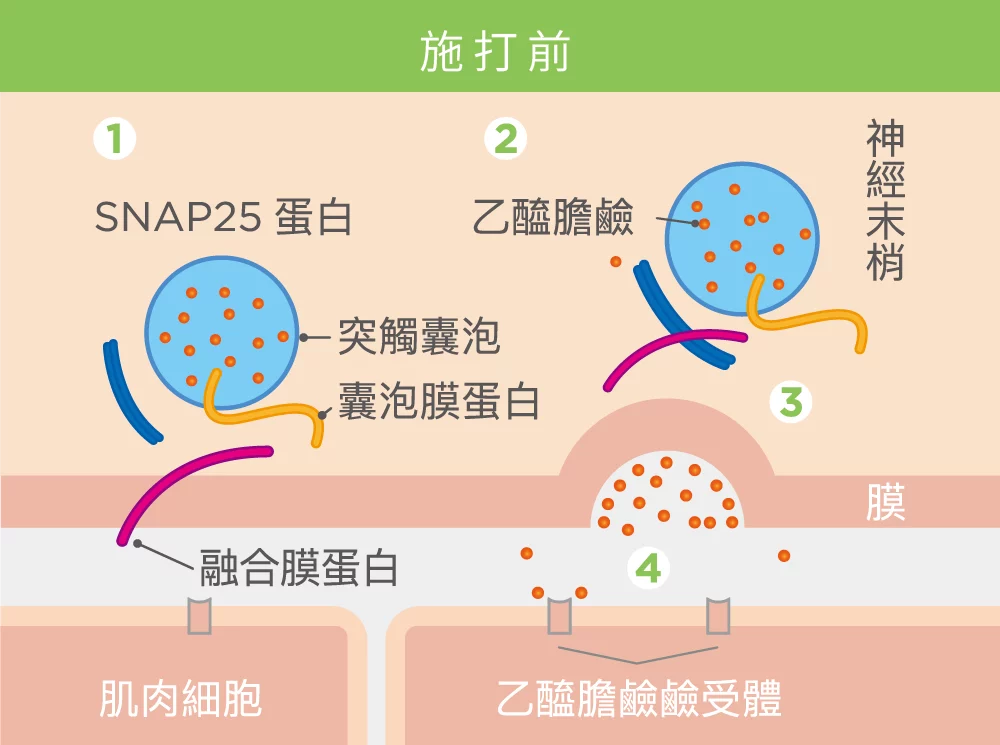 肉毒桿菌 施打前 