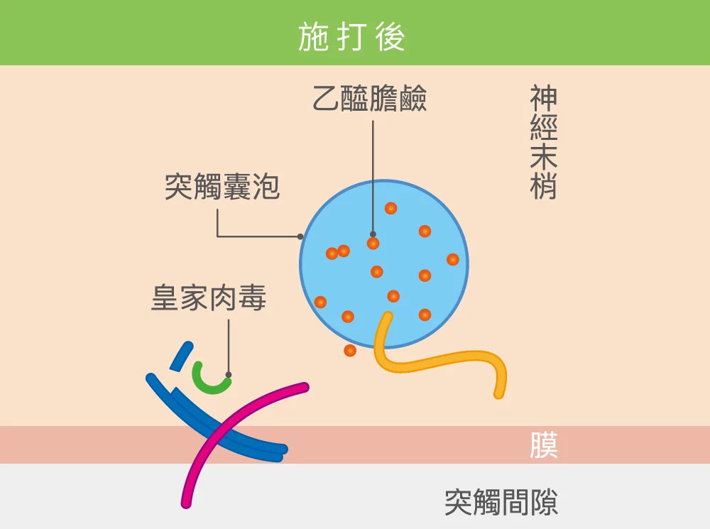 肉毒桿菌 施打後 