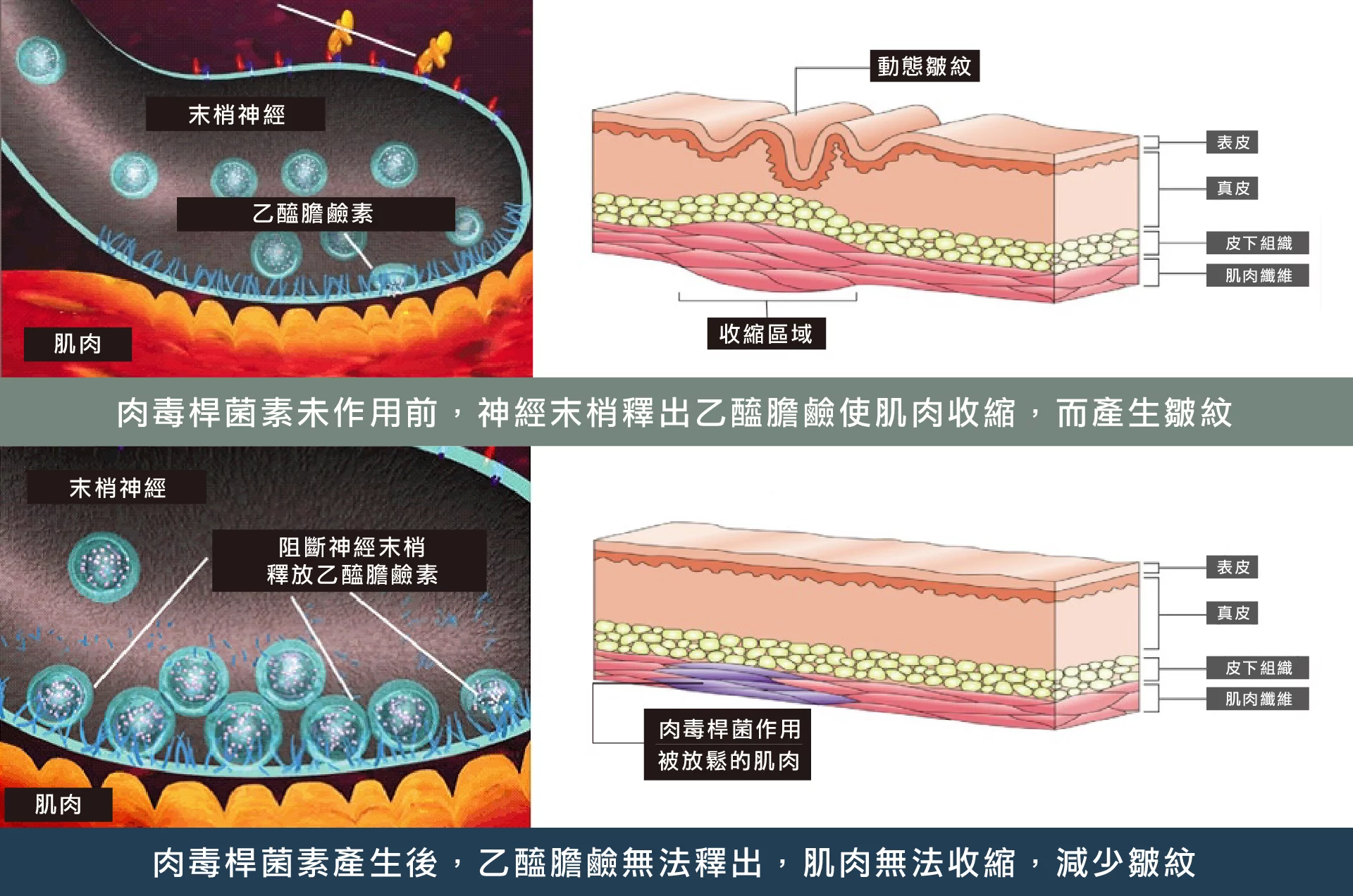 肉毒桿菌 肉毒運作