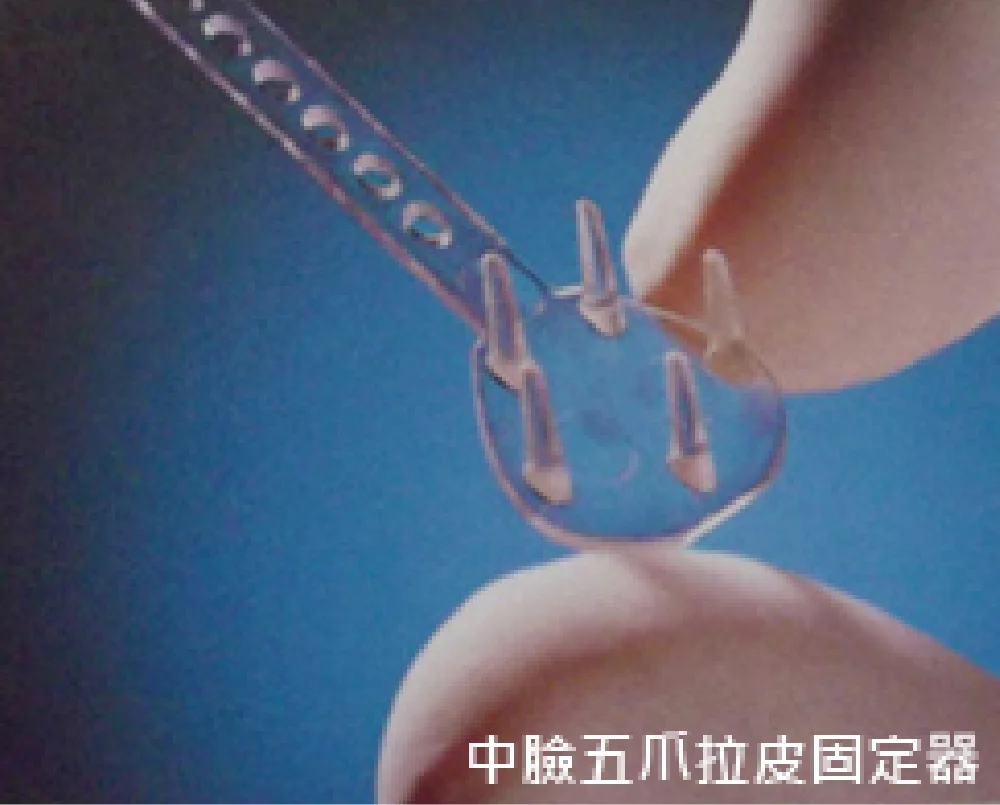 臉部拉皮手術 五爪 中額