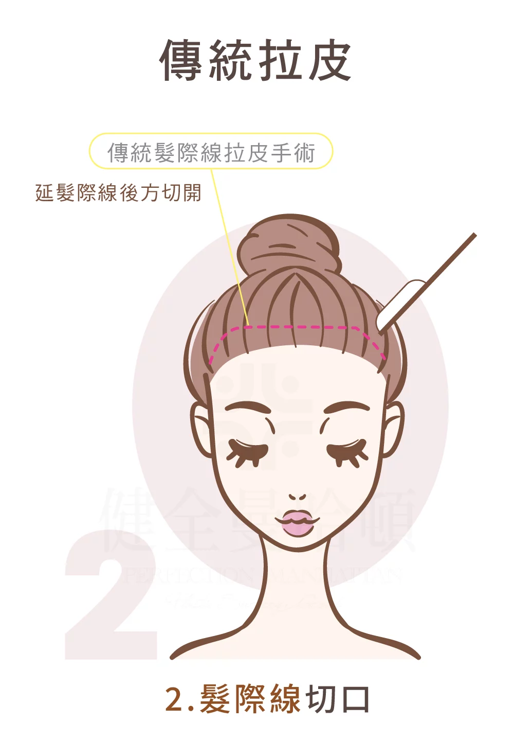 臉部拉皮手術 傳統拉皮 髮際線