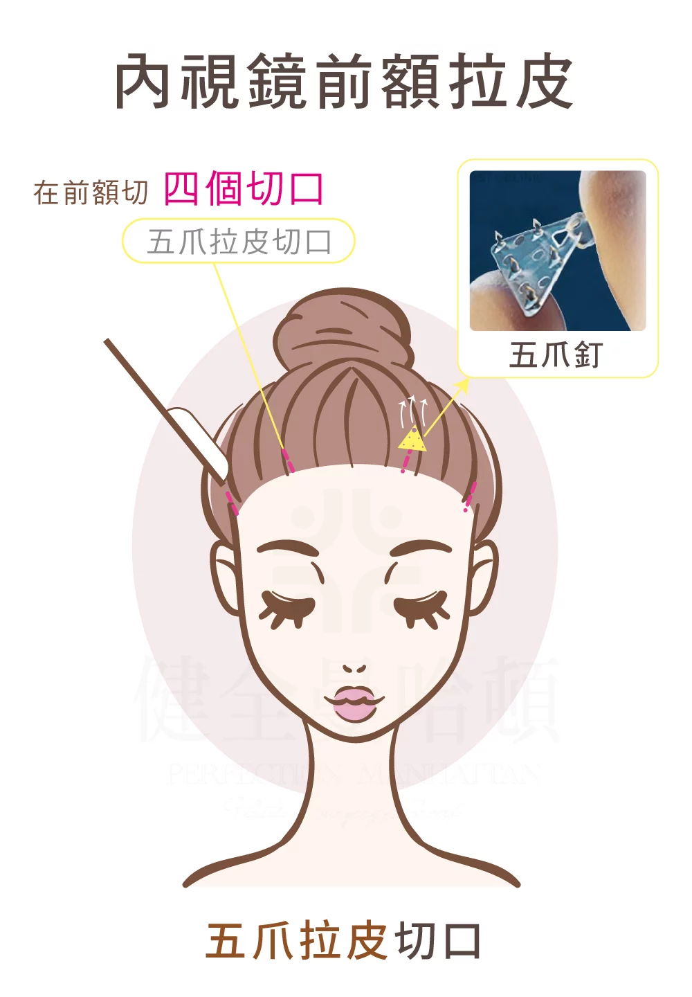 臉部拉皮手術 內視鏡拉皮