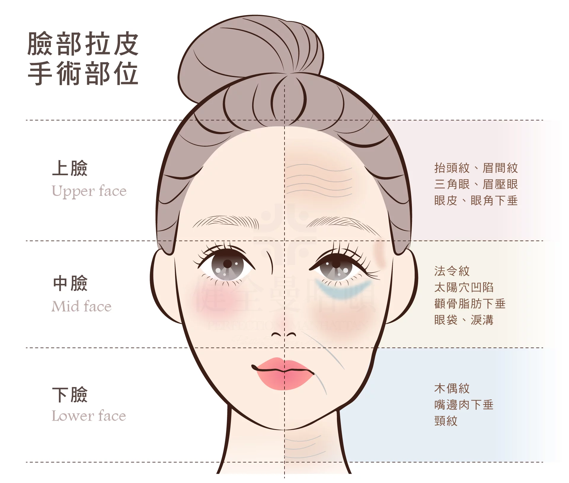 臉部拉皮手術 拉皮部位 