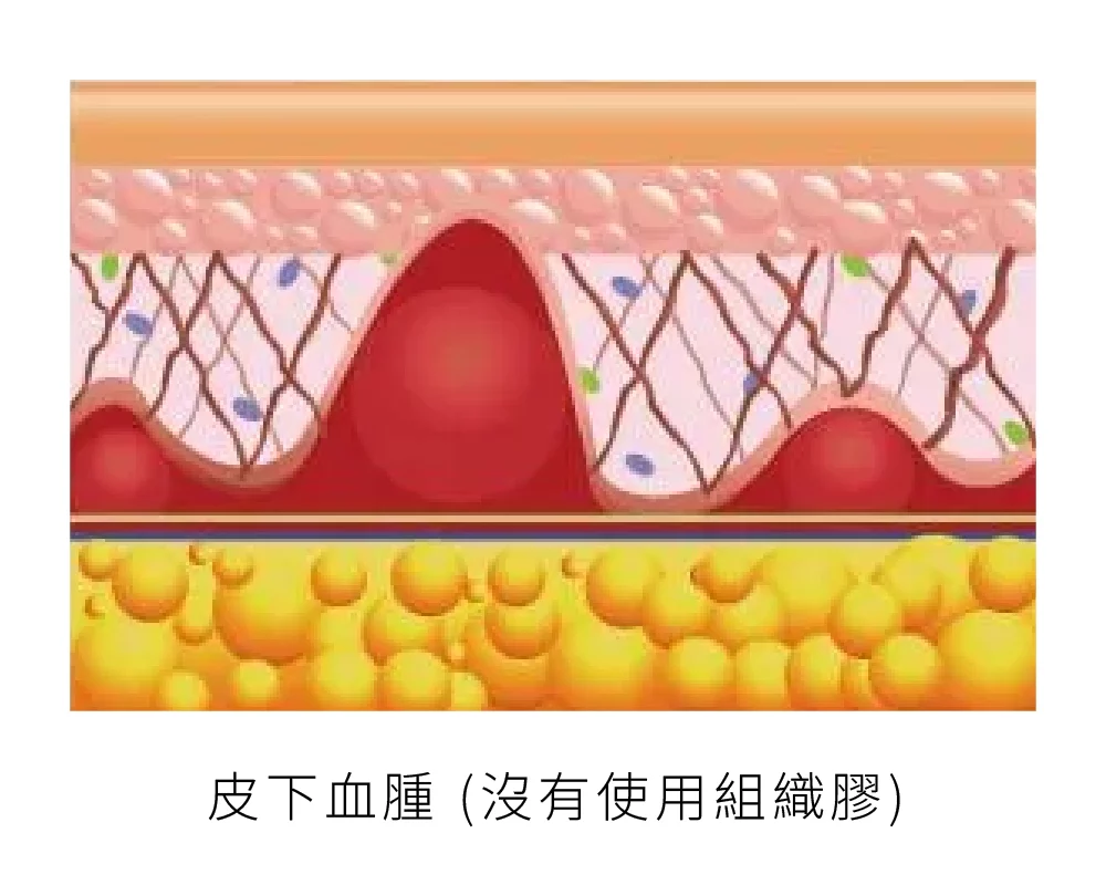 臉部拉皮手術 組織膠 01